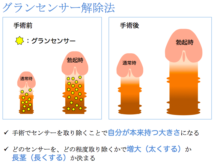 長茎術・切らない長茎術｜MSクリニック