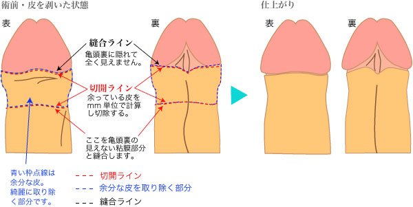 亀頭が痛い、敏感すぎるのは包茎が原因？包茎治療や自力での改善方法を紹介 | メンズライフクリニック【公式】