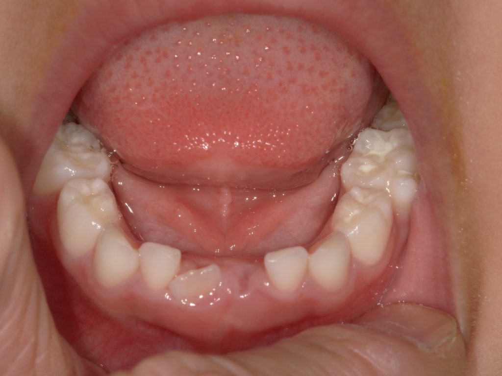 シーラントによる虫歯予防札幌駅北口すぐの歯医者 ポラリス歯科・矯正歯科