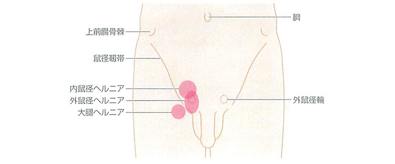 鼠径ヘルニアについて 日帰り手術