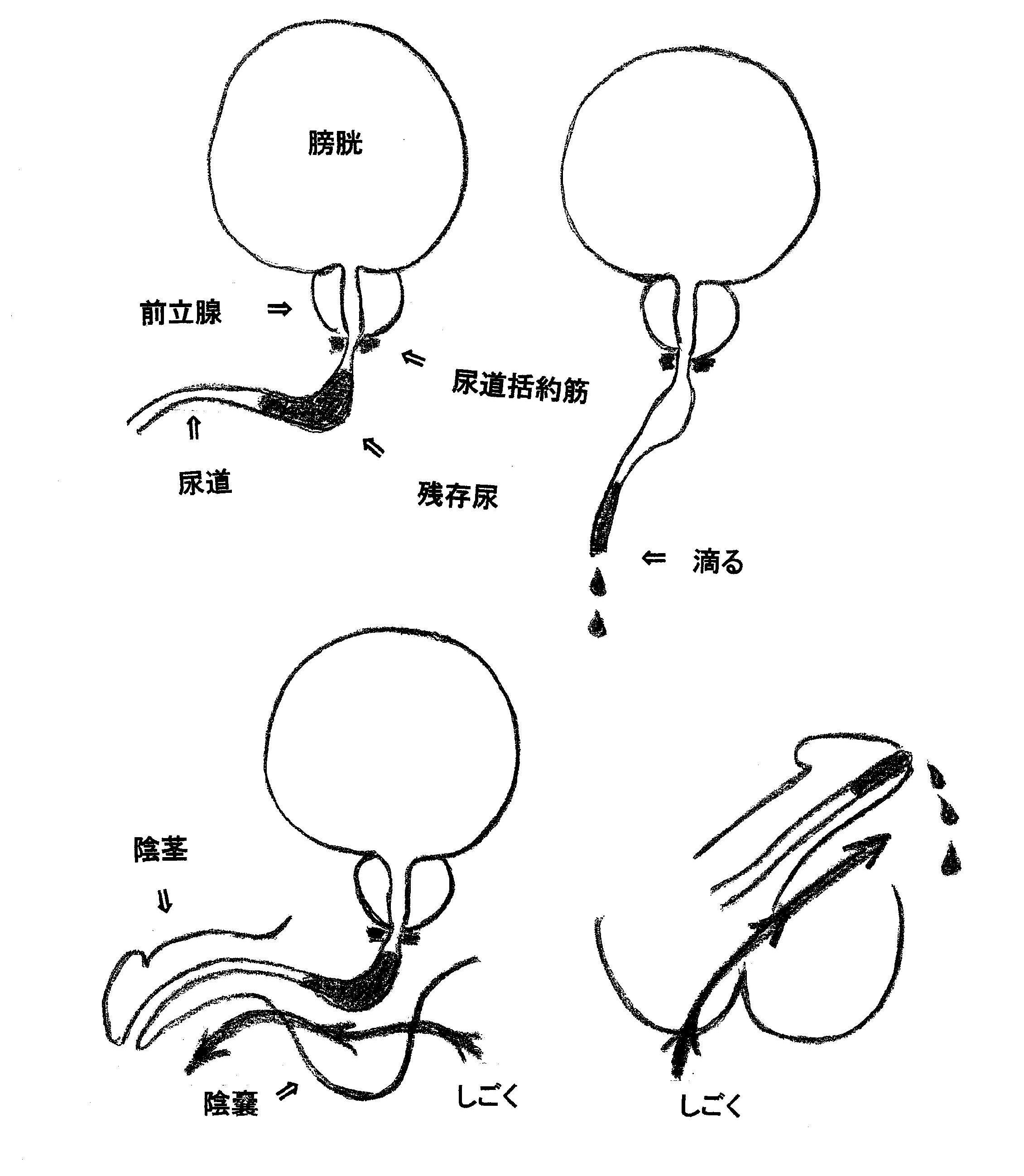 尿道下裂 | みんなの医療ガイド