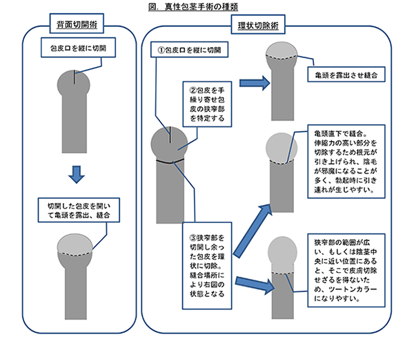 包茎手術・長茎術】６ヶ月後の状態やパートナーの変化は？ | ネオ形成外科