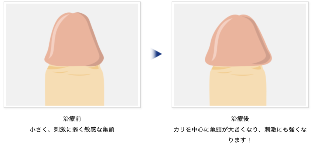 亀頭が痛い、敏感すぎるのは包茎が原因？包茎治療や自力での改善方法を紹介 | メンズライフクリニック【公式】