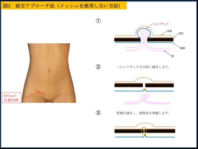 気になる鼠径部のシコリは鼠径ヘルニアかも！？｜ブログ｜Gi外科クリニック