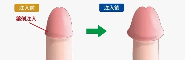 カリ高ペニスになる方法は？カリ高の基準や亀頭を大きくするメリットも解説！ | Men's Chinchi