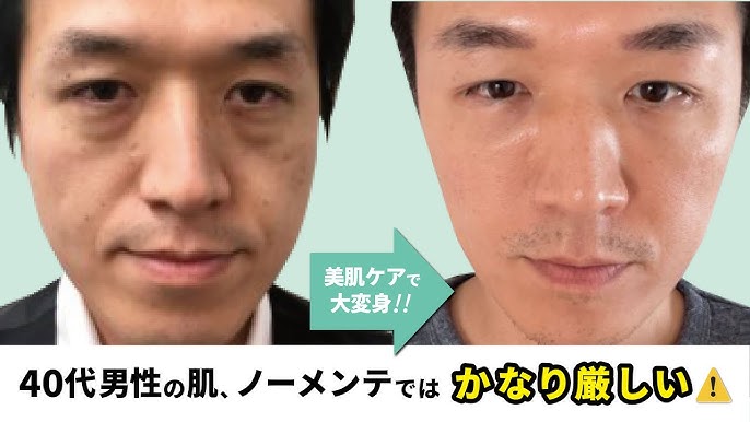 男性の若返り治療！脂肪吸引と糸リフトとは？二重アゴと顔のたるみに悩んでいる40代男性