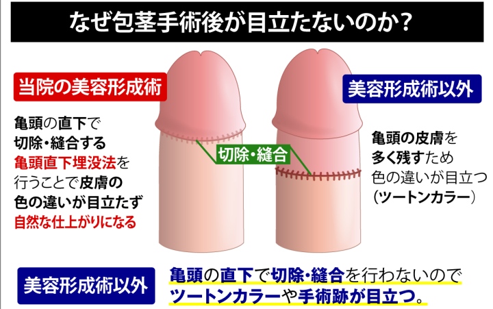 仮性包茎の治し方や改善方法は手術のみ？自力で治す方法の効果や注意点と合わせて解説 | 包茎治療について｜おき泌尿器科クリニック｜富田林市の泌尿器科