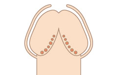 ちんこに真珠を入れたらヤバいって本当？改造ちんこのメリットやデメリット、やり方など徹底解説！ | Men's Chinchi