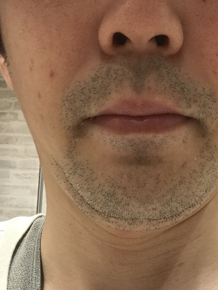 必見 髭脱毛後のどろぼうひげはいつまで続く？抜け落ちるまでの期間と隠すための対策法5選まるわかりメンズ脱毛