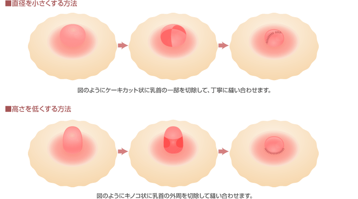 男性の乳頭・乳輪の縮小術は、京都・滋賀の大西皮フ科形成外科医院