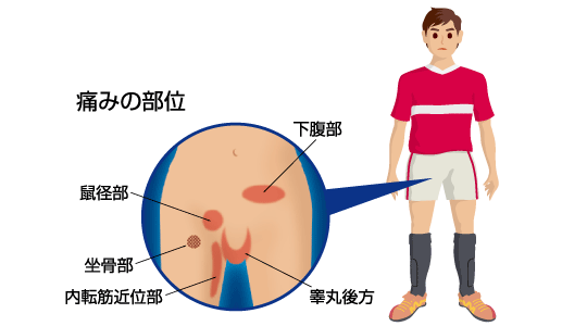 脱腸サポーター 脱腸ベルト 脱腸帯