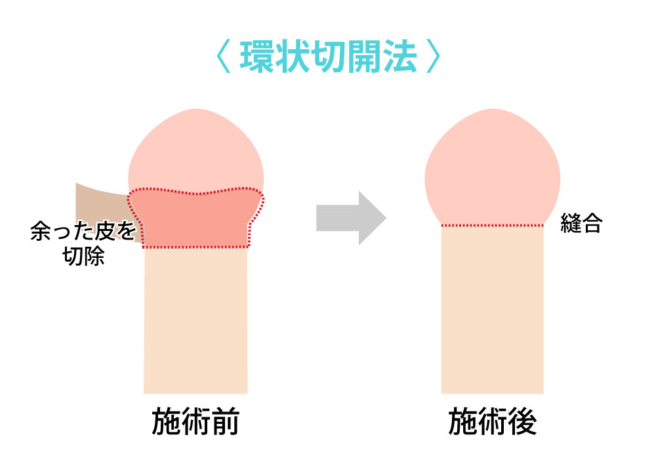 包茎・早漏治療 | 銀座マイアミ美容外科