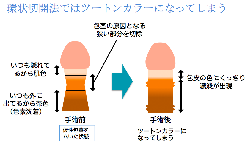 後悔した包茎手術の体験談 オナニー世界王者は世界一の遅漏でもあった - おとなセイシル