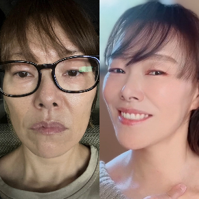 40代からのたるみ改善で笑顔と自信を取り戻す方法エクセレントラインの4ヶ月メソッド体験談