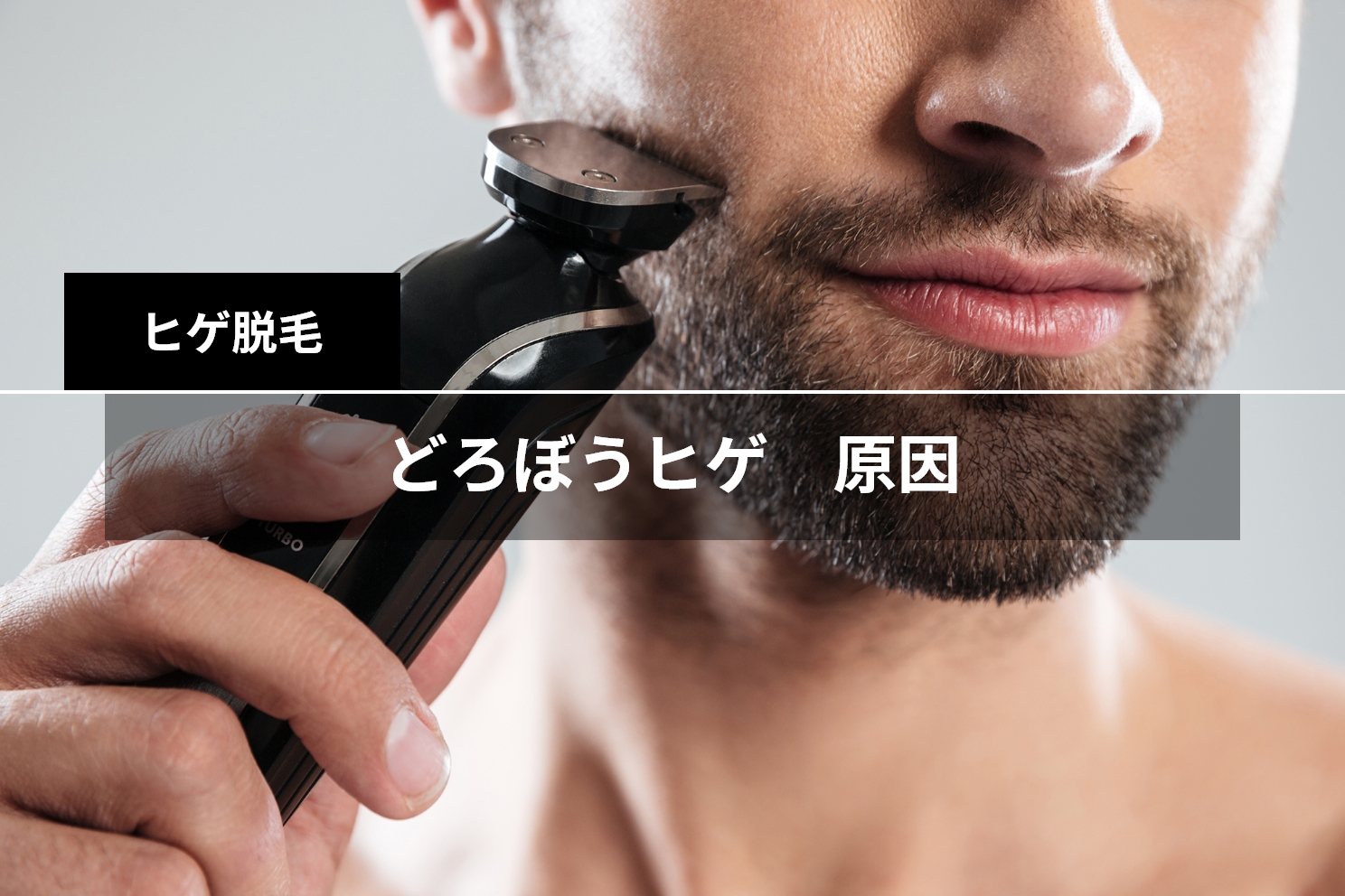 髭10 髭永久脱毛第13回施術、ヤグレーザーの施術後の様子を詳細に記録してみたIda Aha