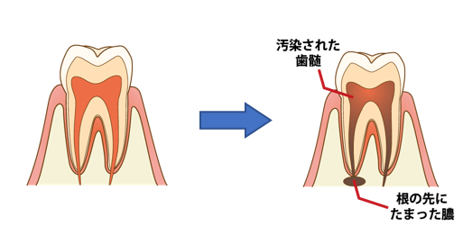 親知らずを抜くメリットとは？｜なんばクローバー歯科 よくあるご質問