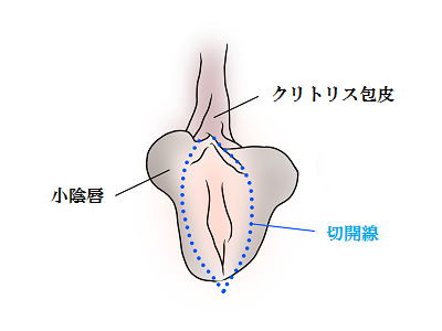 クリトリス包茎と陰核の機能について - 美容外科｜船橋中央クリニック&青山セレスクリニック