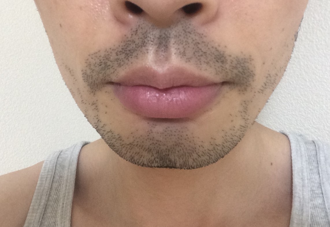 泥棒ヒゲとは？髭が濃い期間と脱毛後のおすすめ対策方法を徹底解説！MOTEO