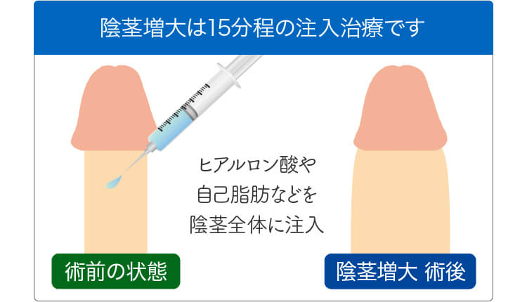 陰茎増大・ペニス増大｜西新宿杉江中央クリニック｜美容外科・形成外科