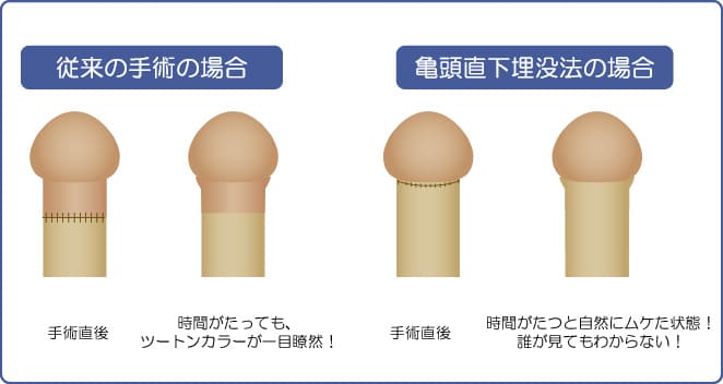 亀頭が刺激に敏感なのは経験値が足りないから。鈍感な亀頭になるための解決策｜あんしん通販コラム