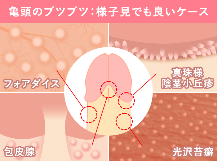 症例写真】亀頭にヒアルロン酸を注射し、カリに張りを出してペニスを増大させた症例の術前術後画像：美容外科 高須クリニック