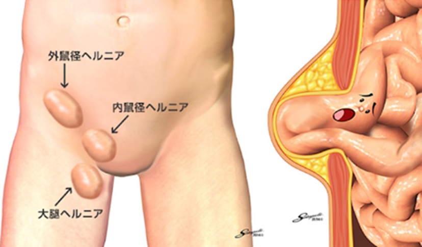 鼠径ヘルニア資料室｜医療法人ひらまつ病院