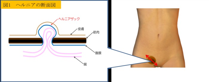 鼠径ヘルニア・陰嚢水腫 | 聖マリアンナ医科大学 横浜市西部病院