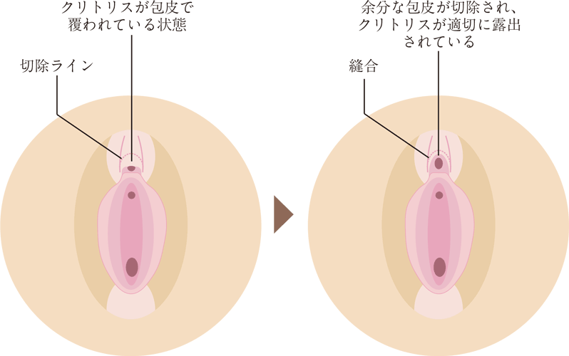 クリトリス包茎手術｜見た目・感度を改善！女性器整形「クリトリス包茎手術」の効果・経過・ダウンタイムとは｜美容整形・美容外科のTAクリニックグループ