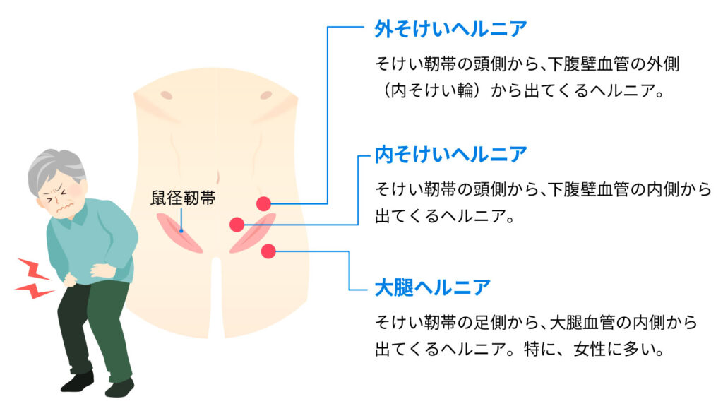 足の付け根（鼠径部）・下腹部が腫れる病気について ～鼠径ヘルニア？他の病気？～ - 西宮敬愛会病院