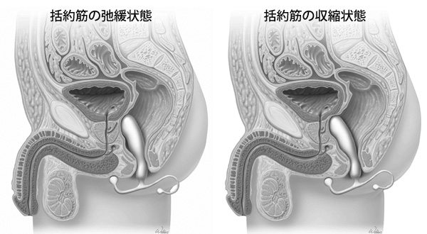 前立腺がんオペ後の尿漏れが治らない！ | 尿もれ頻尿の原因と対策に排泄用具