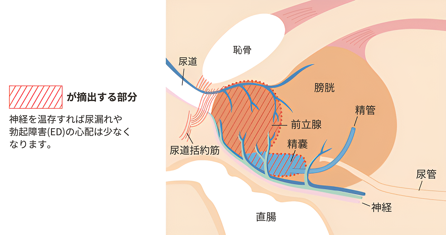 放射線療法｜前立腺がんの治療について｜What's? 前立腺がん