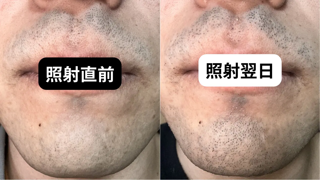 ヒゲ脱毛後のどろぼうひげは何回目まで出る？濃く見える期間と対処法を解説 - MABi