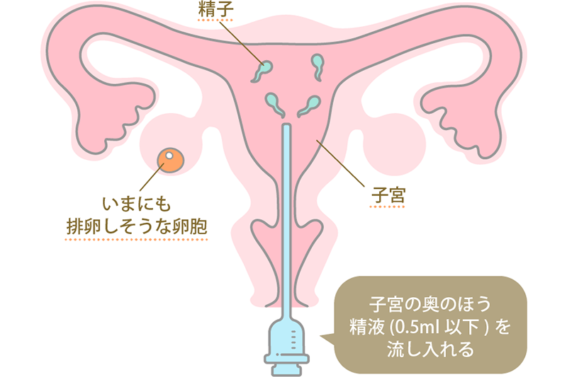 妊娠には精子の質も大切？精子に悪影響な行動＆質を上げるためにできること - プレママクリニック