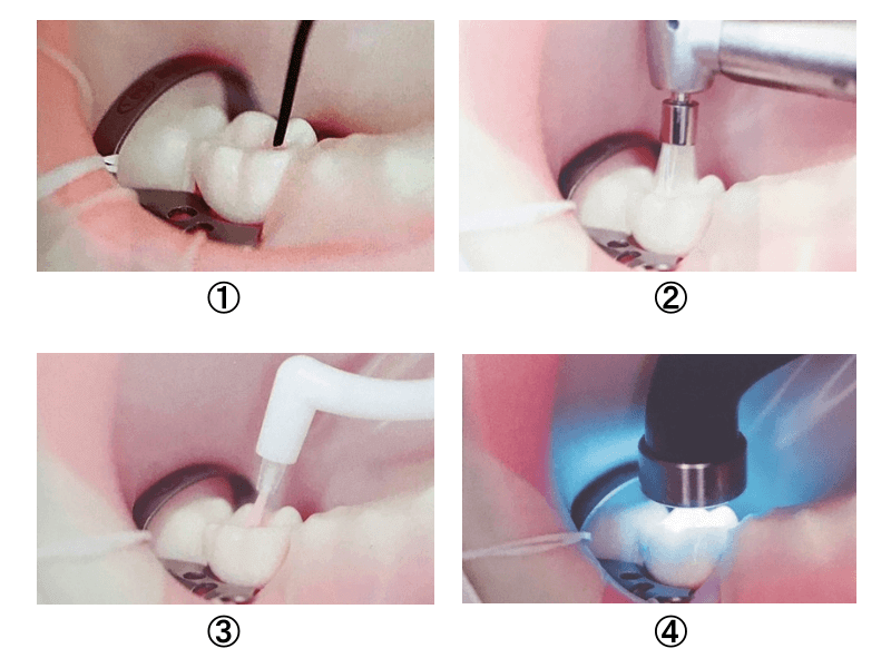シーラントについて紹介☆南森町たむら歯科ブログ
