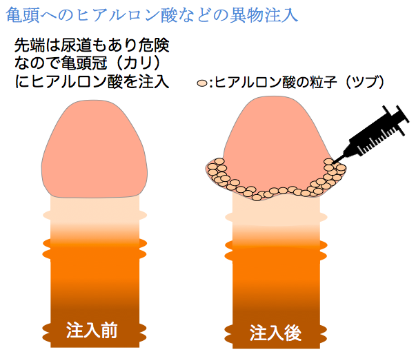 現役医師が解説】炭酸水でペニスが大きくなる！？ – メンズ形成外科 | 青山セレス&船橋中央クリニック