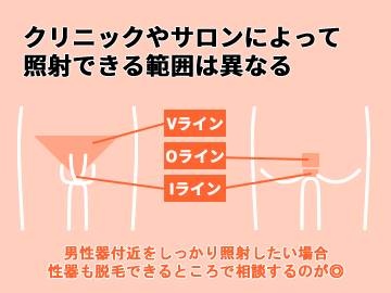 Oライン脱毛 | メンズ永久脱毛・男性医療脱毛ならゴリラ脱毛