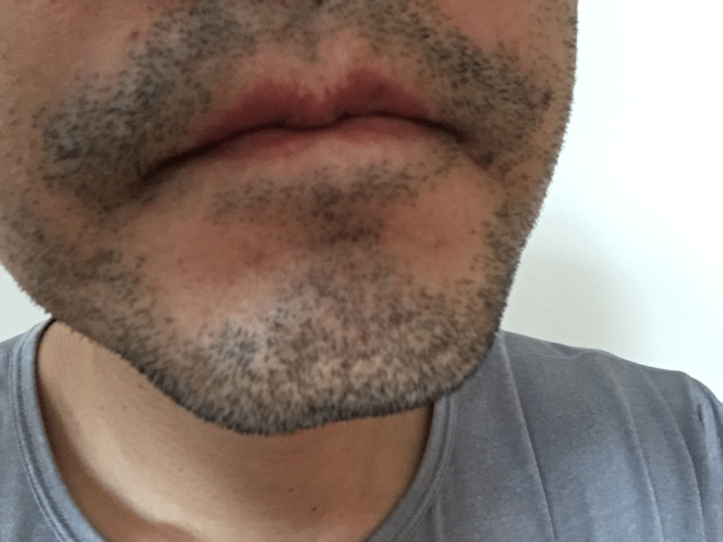 8回目体験記比較写真付き 湘南美容クリニックのヒゲ脱毛 - とものヒゲ脱毛ブログ