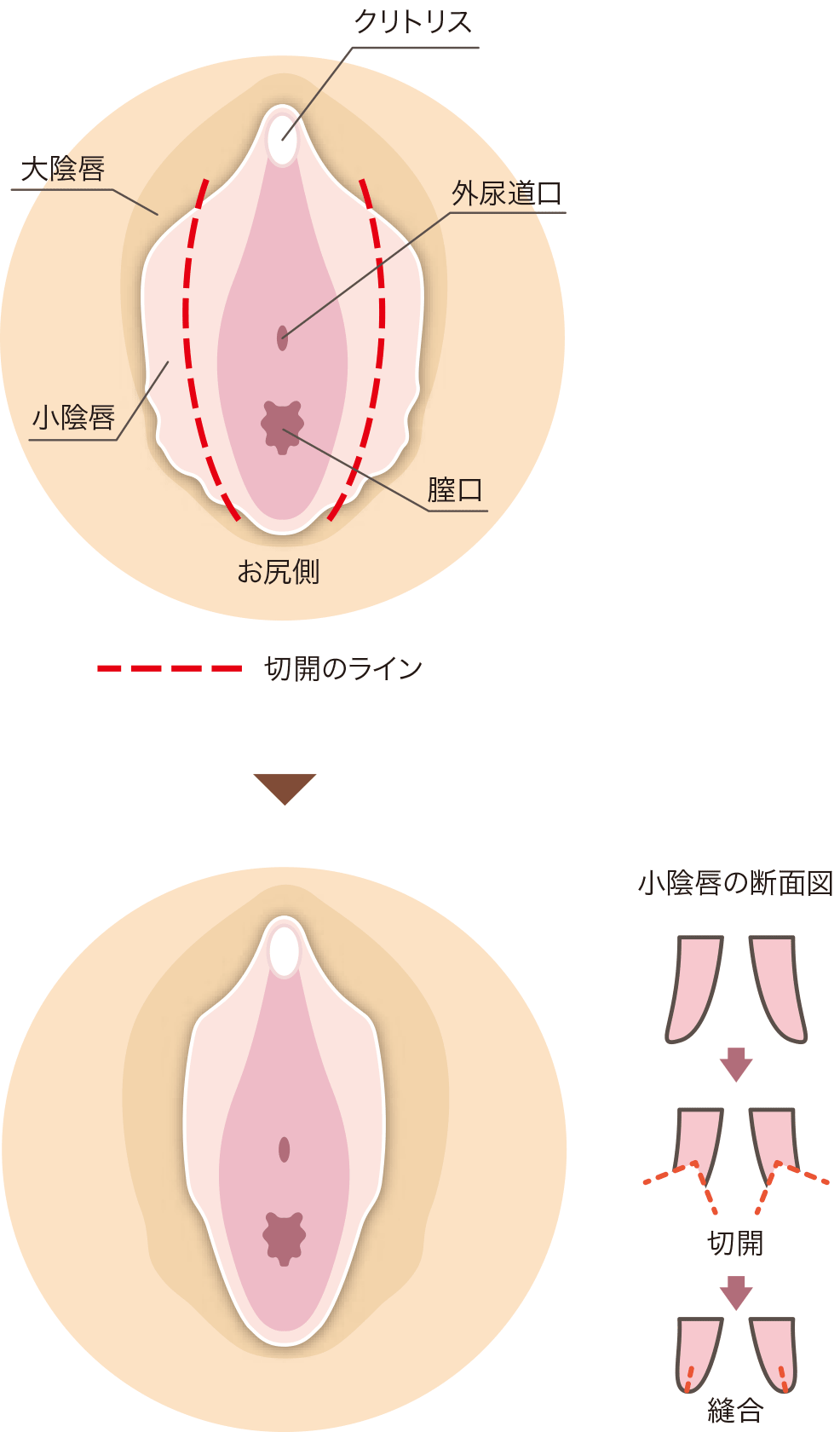 クリトリス包茎 | 婦人科形成なら城本クリニック