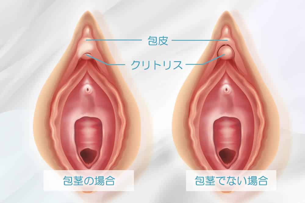 小陰唇縮小術｜びらびらを切除する婦人科形成｜新宿駅前婦人科クリニック【東京】