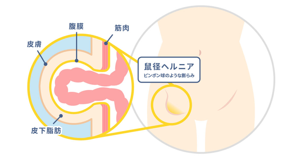 鼠径ヘルニア手術、TAPP法と外切開法の違いを徹底解説 | 鼠径ヘルニア日帰り外科広島アルプスクリニック