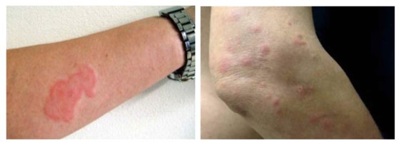 トコジラミはいなくなった？冬を越えたらまた出てくるのか大洋防疫ブログ