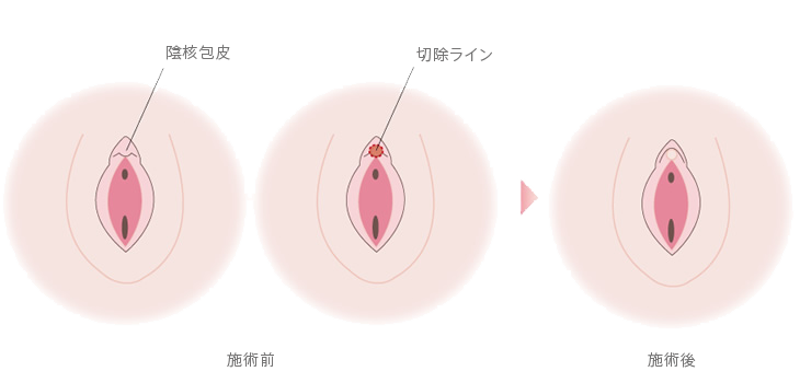 小陰唇のお悩み|福岡ブリスクリニック