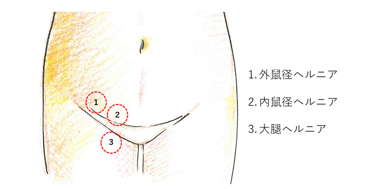 鼠径ヘルニア（脱腸）の初期症状は何ですか？ - 鼠径ヘルニア(脱腸)日帰り手術専門 新橋DAYクリニック【公式】ー東京新橋駅前徒歩1分