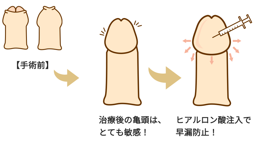 ペニスの構造と包茎の特徴｜包茎の手術や治療は認定専門医に！[東京・大阪]