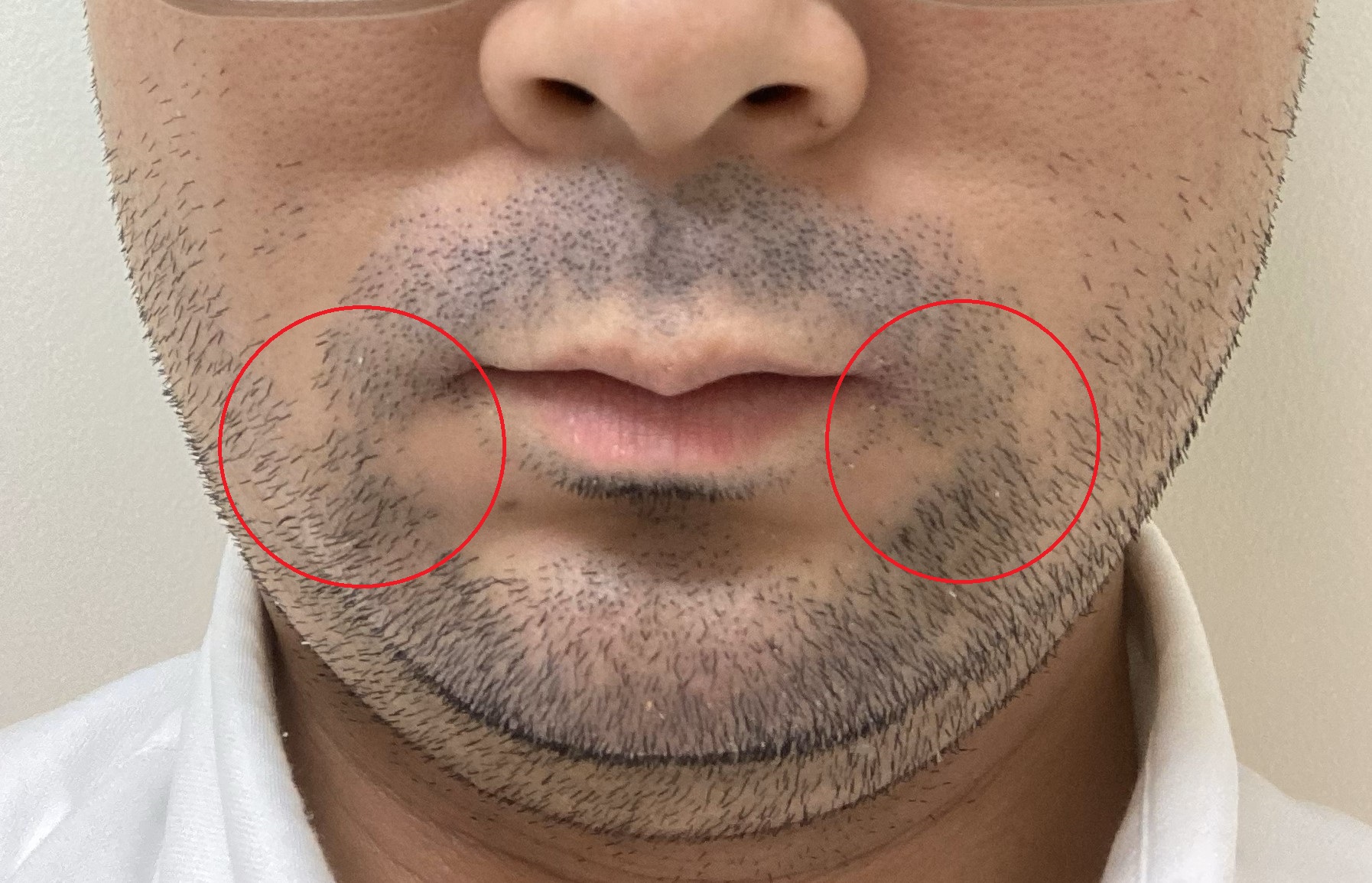 ヒゲ脱毛したら逆に濃くなった！？泥棒ヒゲになる原因「硬毛化」の対策を解説メンズタイムズ