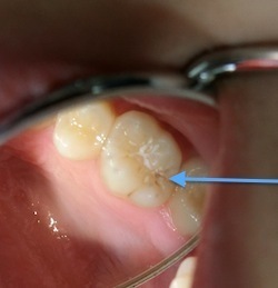 シーラント予防填塞予防歯科の茨城県笠間市友部の歯医者 たち歯科