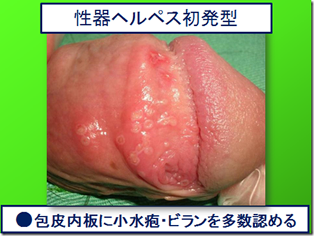 スキン着用ソープ店で勤務したのちに発症したヘルペスとコンジローマの混合感染の一例｜東京・性病検査・安い｜銀座ヒカリクリニック