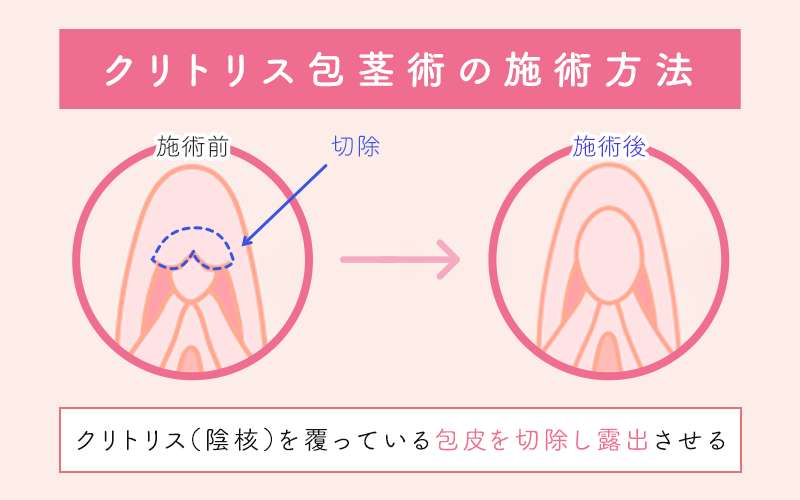 クリトリス包茎 | 婦人科形成なら城本クリニック