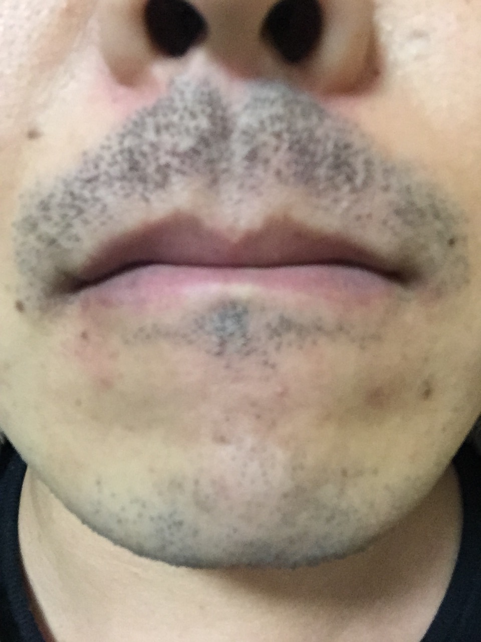 ヒゲ脱毛後のどろぼうひげは何回目まで出る？濃く見える期間と対処法を解説 - MABi