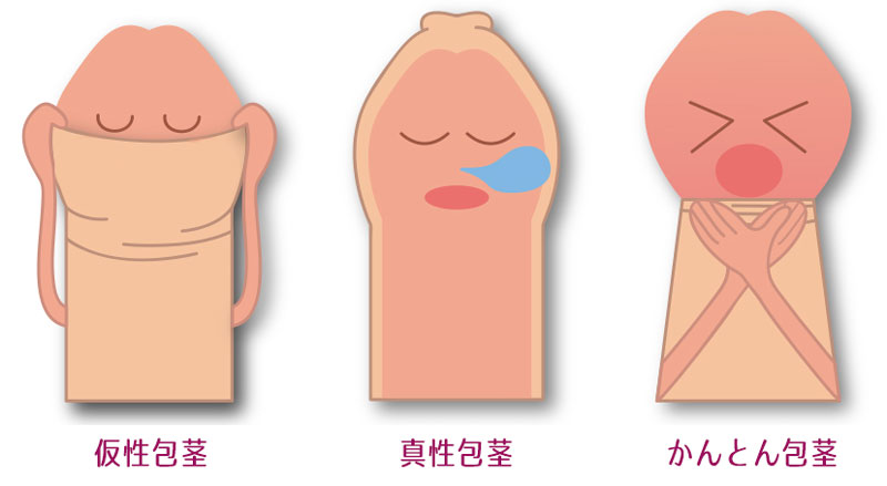 短小包茎とは！短小は何センチから？日本人の平均サイズや治療法 - アトムクリニック - atom-clinic